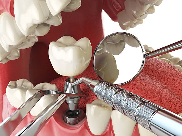 Best Emergency Dental Care for Sports Injuries in Summerville, SC